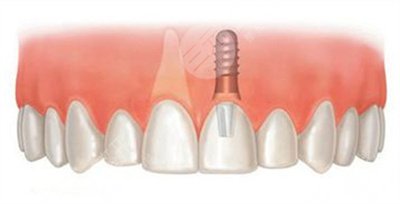 昆明种植牙案例