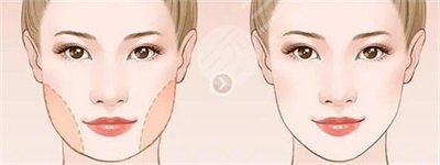 南京华美面部填充案例