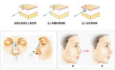 南京华美面部填充案例
