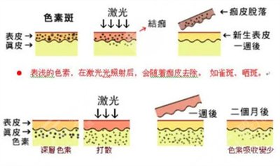 北京大学第三医院整形科激光祛斑案例