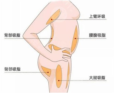 北京新星靓医院大腿吸脂案例