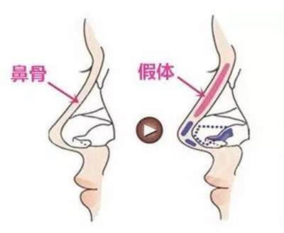 上海知颜医疗美容硅胶隆鼻案例