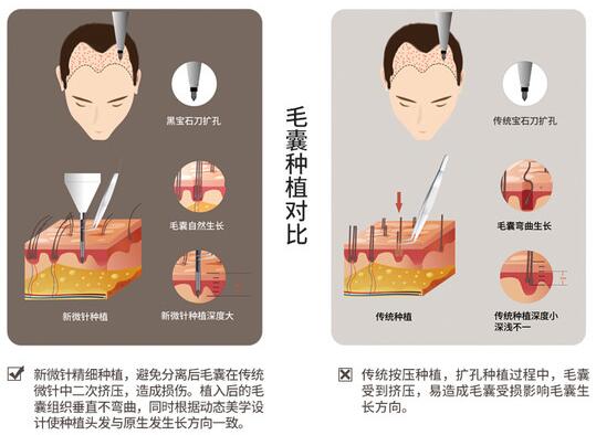 西安熙朵植发科普手术相关知识