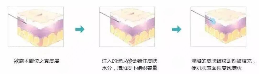 玻尿酸除皱