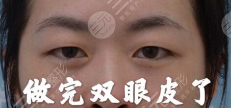 安徽中医药大学第一附属医院整形科割双眼皮前