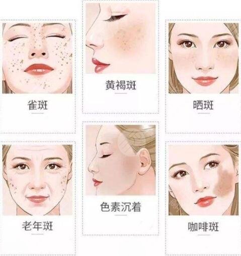 祛斑术前