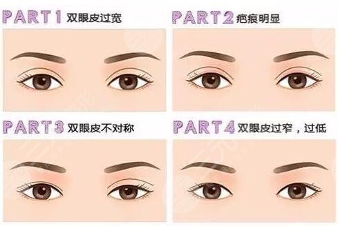 做双眼皮手术之后