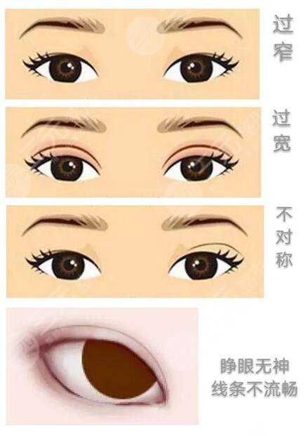 双眼皮案例