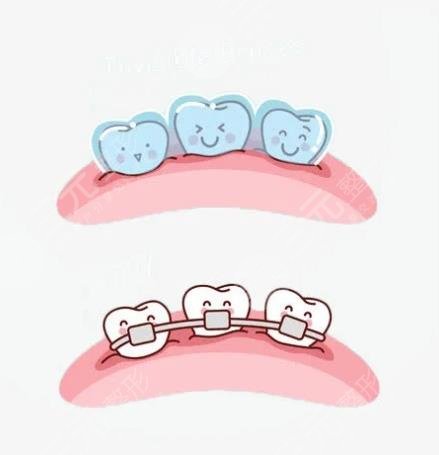 金属矫正牙齿有哪些优缺点?适用于哪些人?