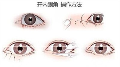 开外眼角前后对比果图