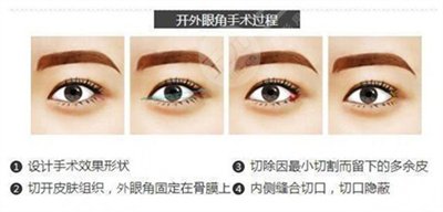 开外眼角前后对比果图