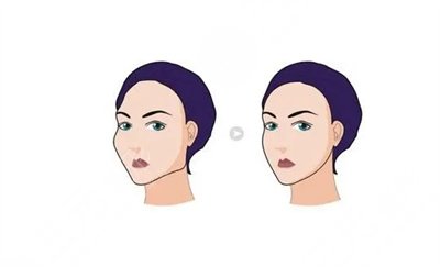 上海九院下颌骨案例术前