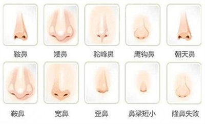 钱云良专家鼻修复案例