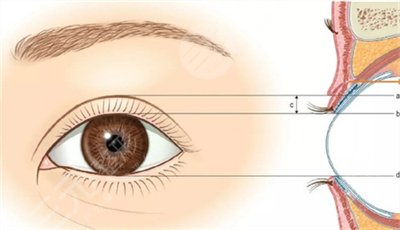 【案例】吉大一院赵自然双眼皮多少钱？双眼皮开眼角真人图~