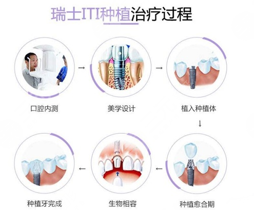牙齿种植体十大排名