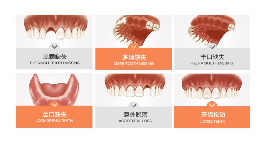 种植牙手术知识科普