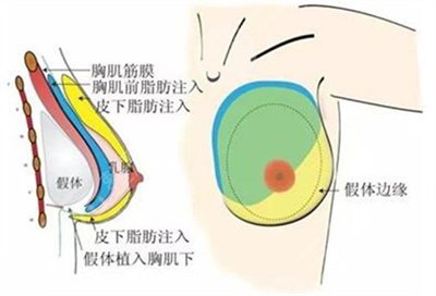 禾丽整形医院假体隆胸案例术前