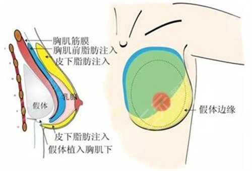 广州星念整形医院怎么样？价格表丨医生名单丨张元龙隆胸案例~
