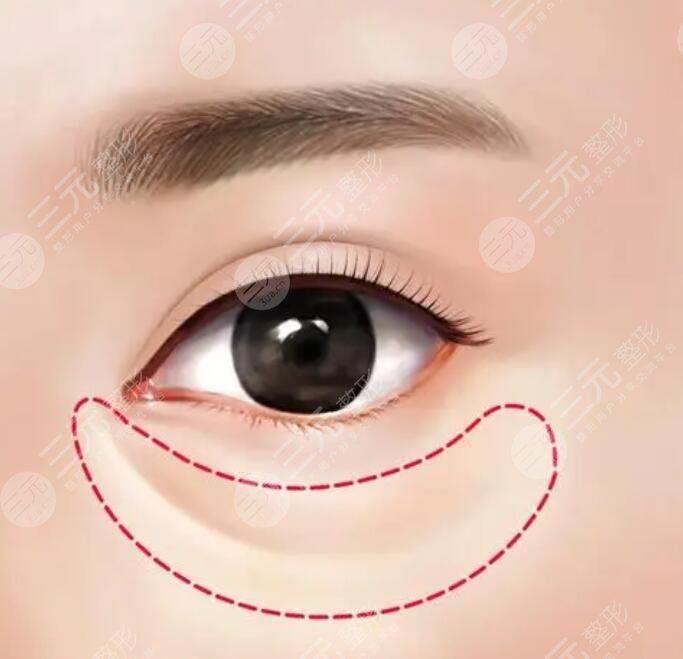 手术去眼袋