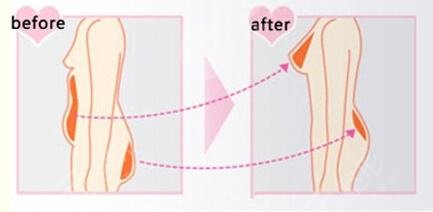 丰胸脂肪填充多少钱？更新自体隆胸价格表大全，必备！