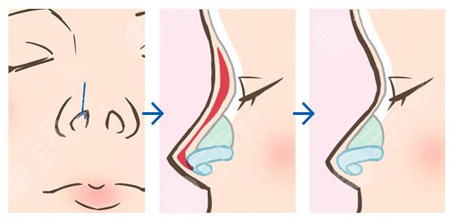 上海九医院隆鼻假体取出多少钱啊？鼻修复价格表全新发布！