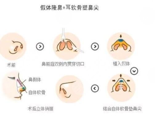 隆鼻