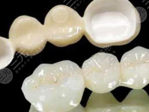 氧化铝烤瓷牙套