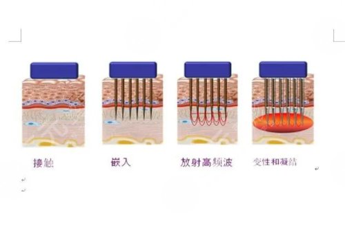 美莱黄金微针多少钱做一次?