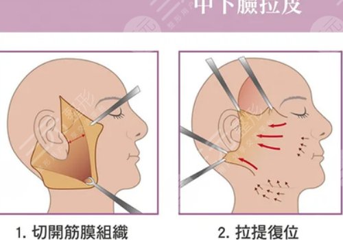 北医三院拉皮手术多少钱?