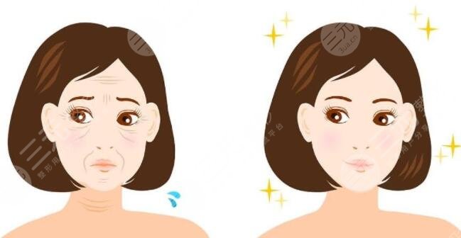 内窥镜中面部提升价位是多少?技术操作原理及价格高低影响因素