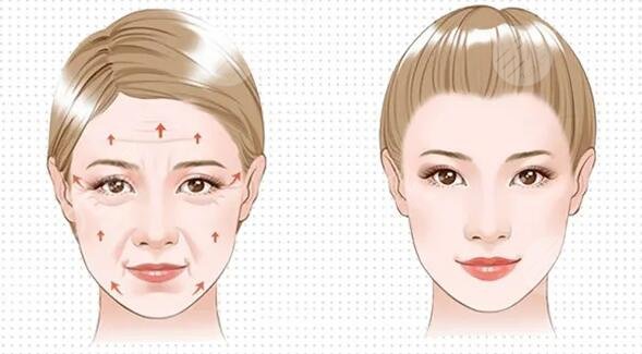 冰电波拉皮除皱的效果怎么样?