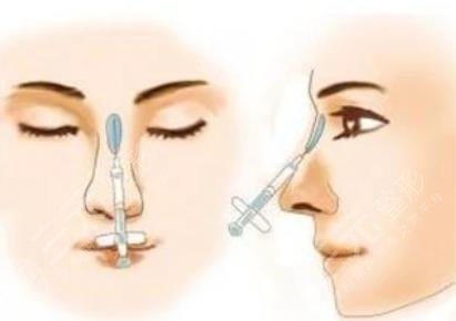 打玻尿酸隆鼻的价格是多少