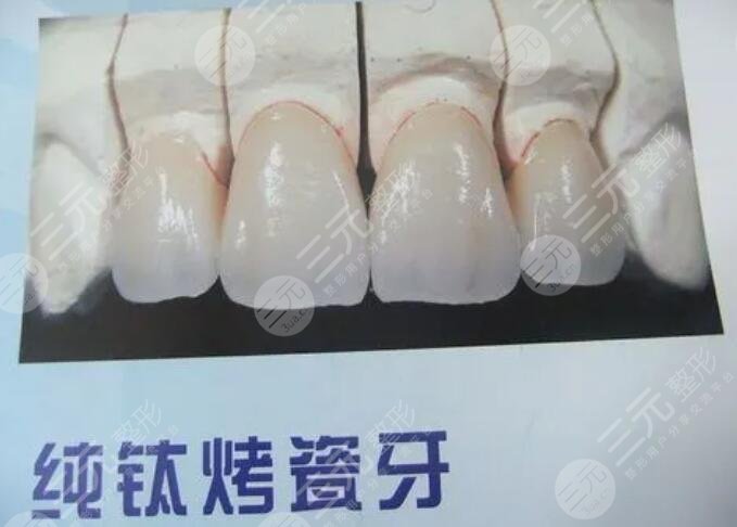 2025纯钛烤瓷牙的价格是多少?