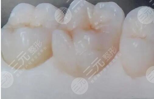 影响纯钛烤瓷牙价格的因素有哪些?
