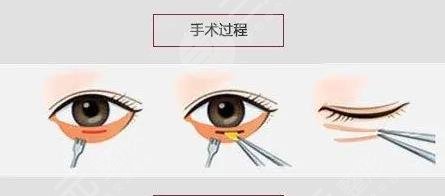 眼袋吸脂手术费用大概多少？
