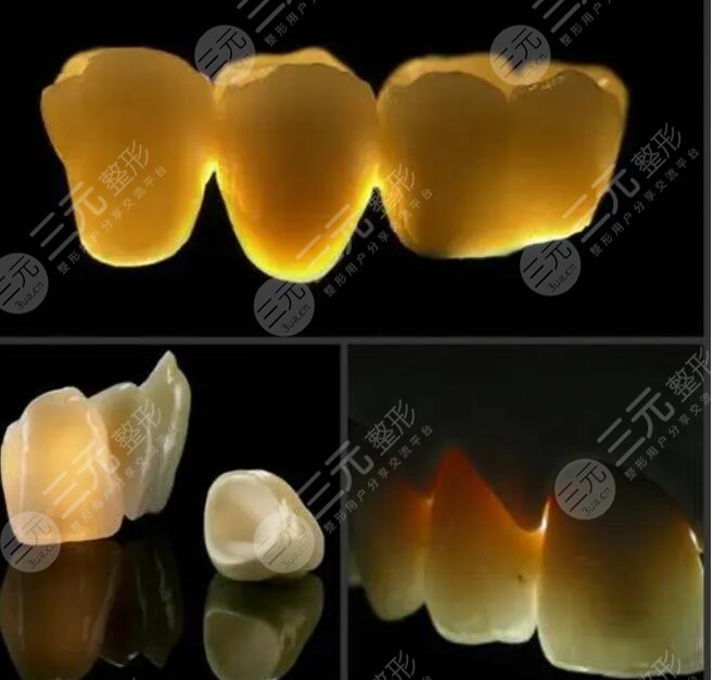 成都烤瓷牙价格查询