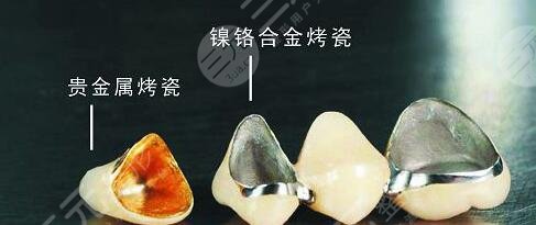 做完烤瓷牙后需要注意事项都有哪些?