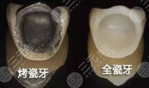 烤瓷牙做完后能够坚持多久?