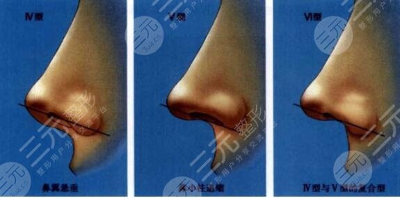 鼻修复手术