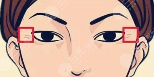 鱼尾纹