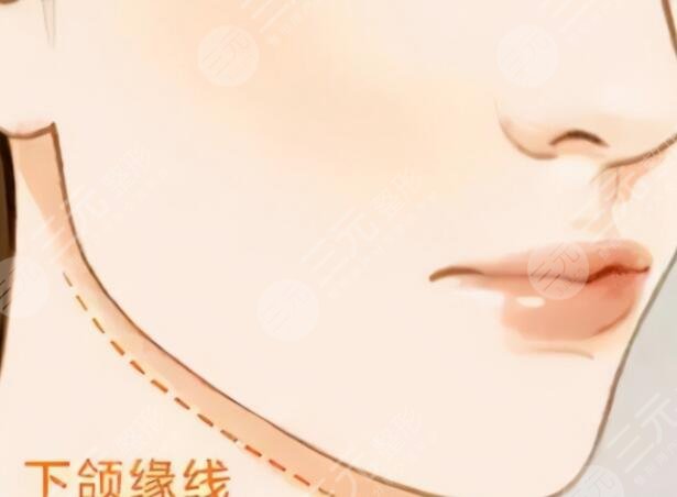 下颌角整形手术