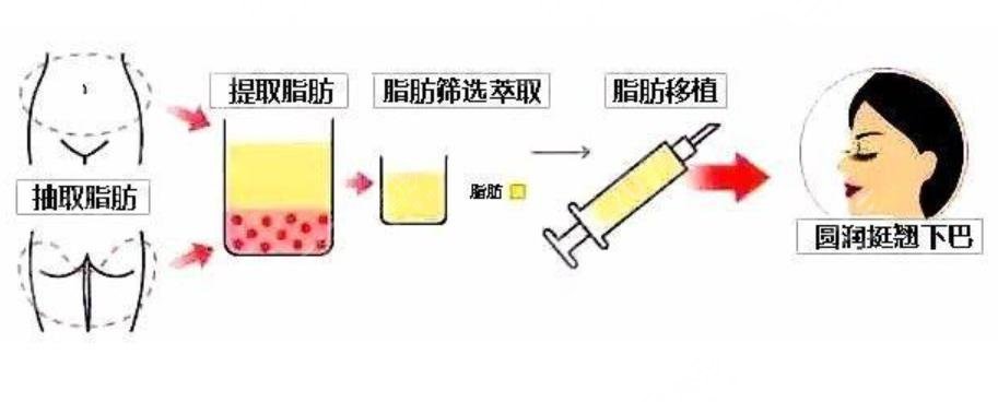 自体脂肪丰下巴