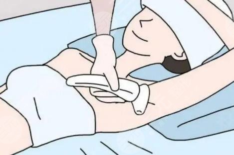 脱毛