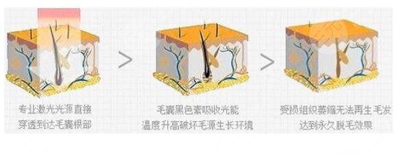 面部激光脱毛