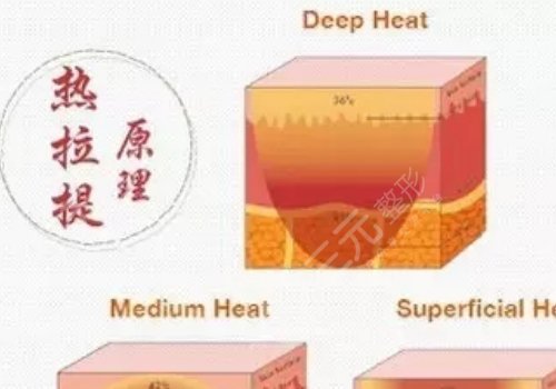成都热拉提价格是多少?费用明细参考