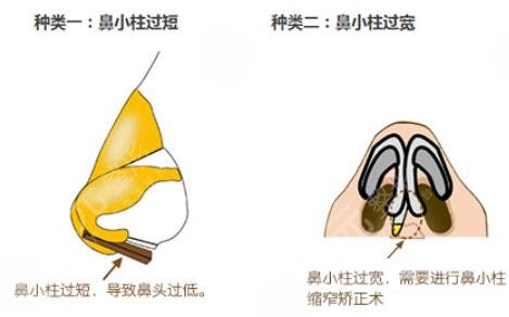 高顺福做鼻子价格表2025