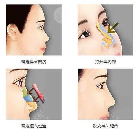 隆鼻整形手术