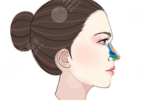 骨胶原隆鼻一般多少钱？