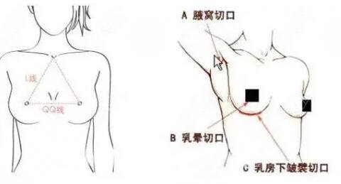 隆胸整形手术