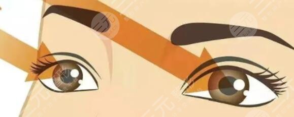 双眼皮